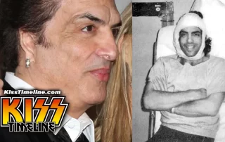 On 26. February, 1982, Paul Stanley underwent reconstructive surgery by Dr. Frederic Rueckert, a New Hampshire-based reconstructive surgeon, who successfully built Stanley a new right ear using cartilage removed from his rib cage. Paul suffered congenital ear deformity called Grade 3 Microtia.