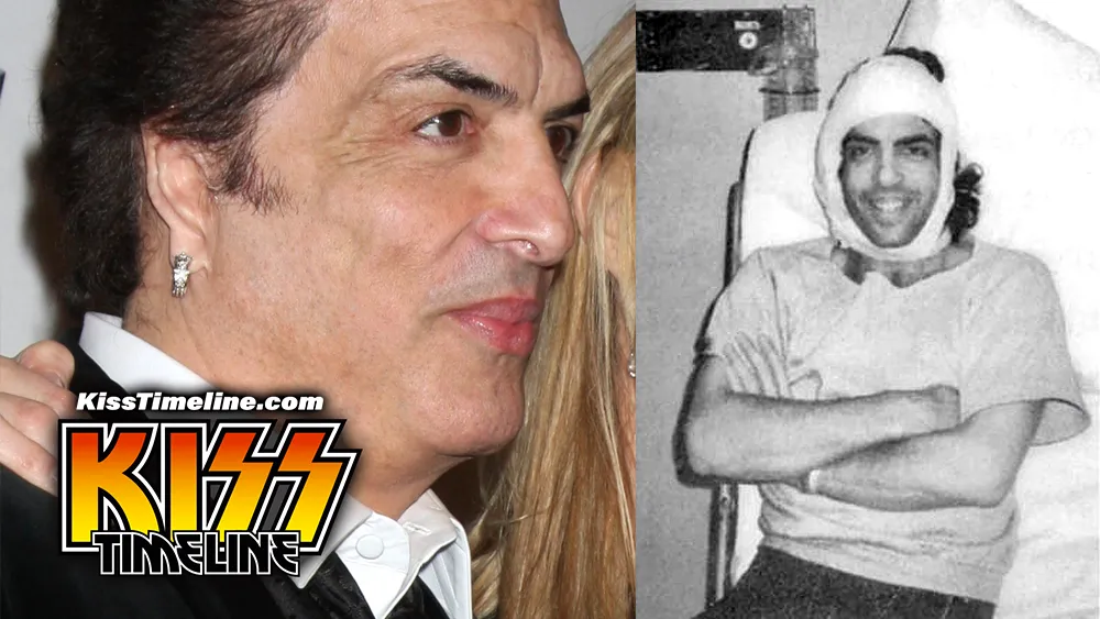 On 26. February, 1982, Paul Stanley underwent reconstructive surgery by Dr. Frederic Rueckert, a New Hampshire-based reconstructive surgeon, who successfully built Stanley a new right ear using cartilage removed from his rib cage. Paul suffered congenital ear deformity called Grade 3 Microtia.